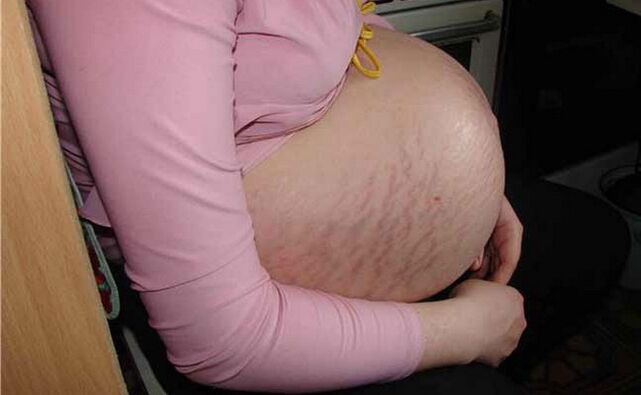 Ursachen für Krampfadern während der Schwangerschaft