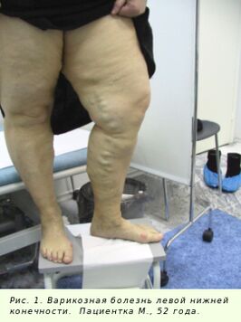 Krampfadern müssen behandelt werden, um den Prozess zu stoppen