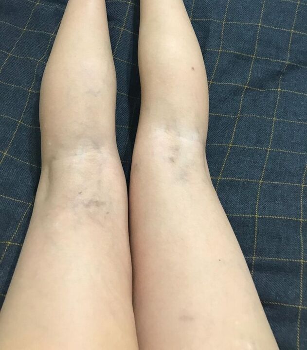 Manifestationen von Krampfadern an den Beinen